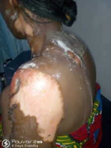 UNIJOS lecturer allegedly pours hot water on wife (Graphic Photos) (2)
